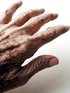 Parkinzonos beteg keze Parkinzonos beteg keze